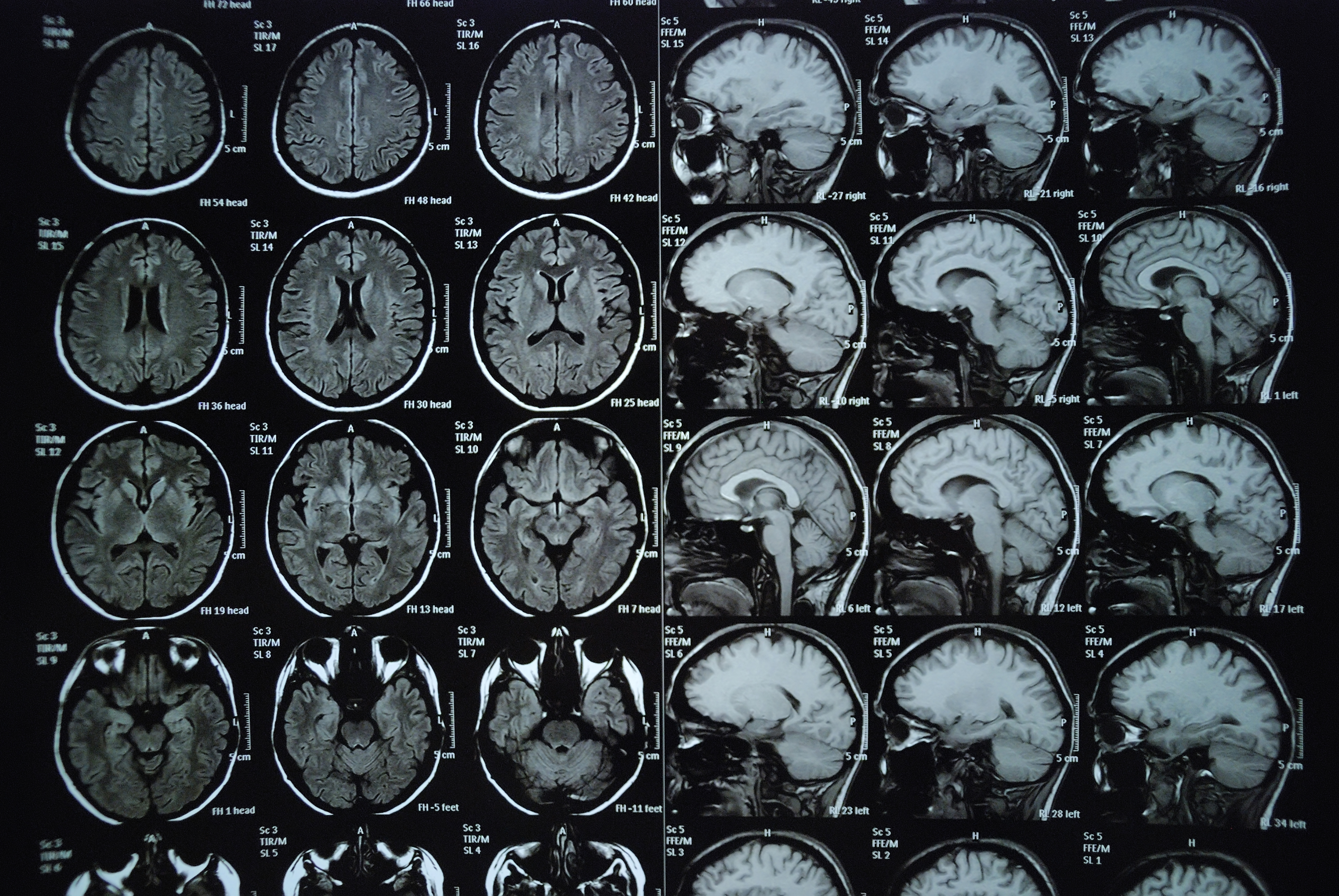 Кт головы стоя. Мрт мозга вид сбоку. Магнитно-резонансная томография головного мозга обзорная. MRI головного мозга. Магнитно резонансные томограммы головного мозга.
